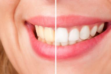 Zoom Teeth Whitening